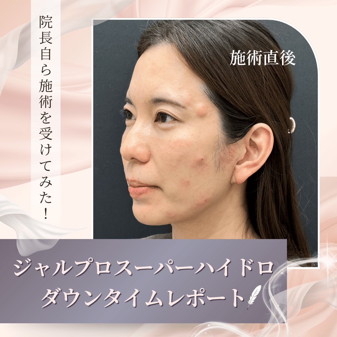 【かおり院長自ら体験👩🏻‍⚕️】ジャルプロスーパーハイドロのリアルな効果とダウンタイムを大公開❣️